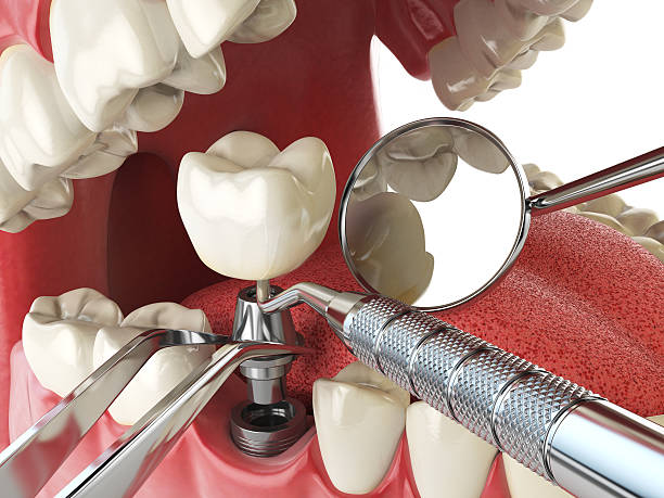 Best Root Canal Emergency Dentist  in Graham, WA